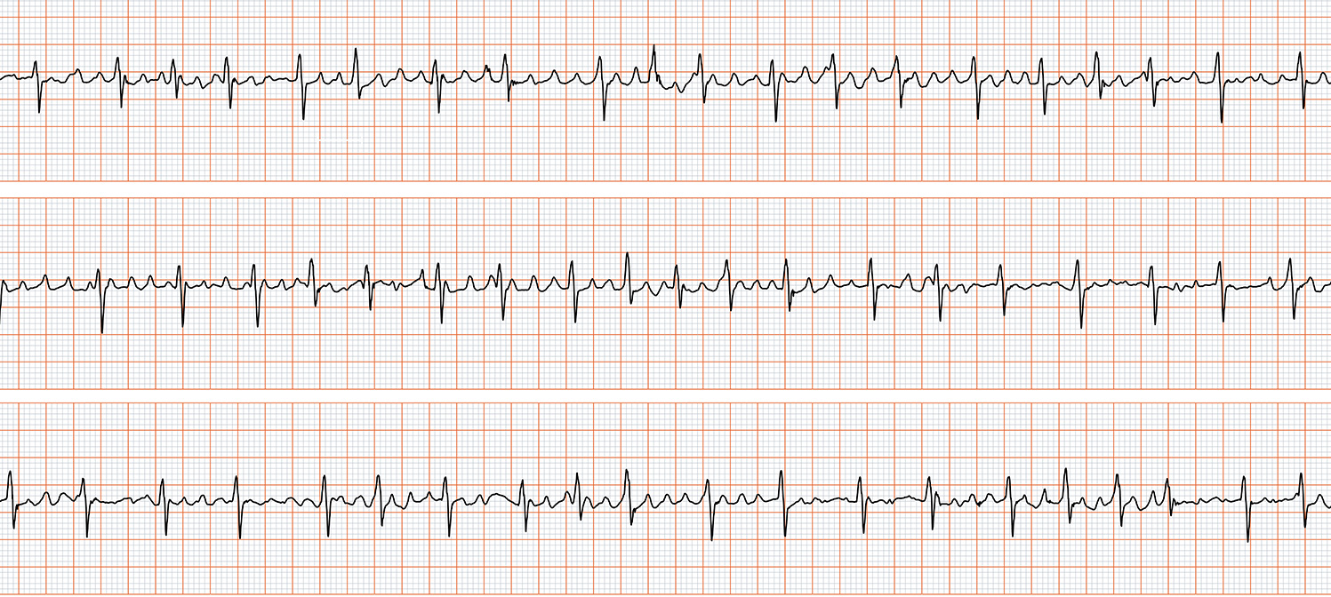 electrocardiogramme