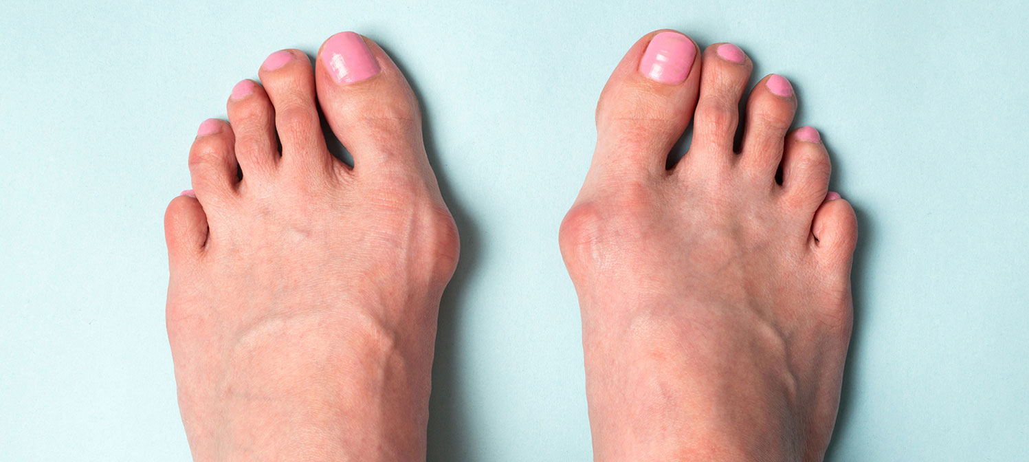 hallux valgus