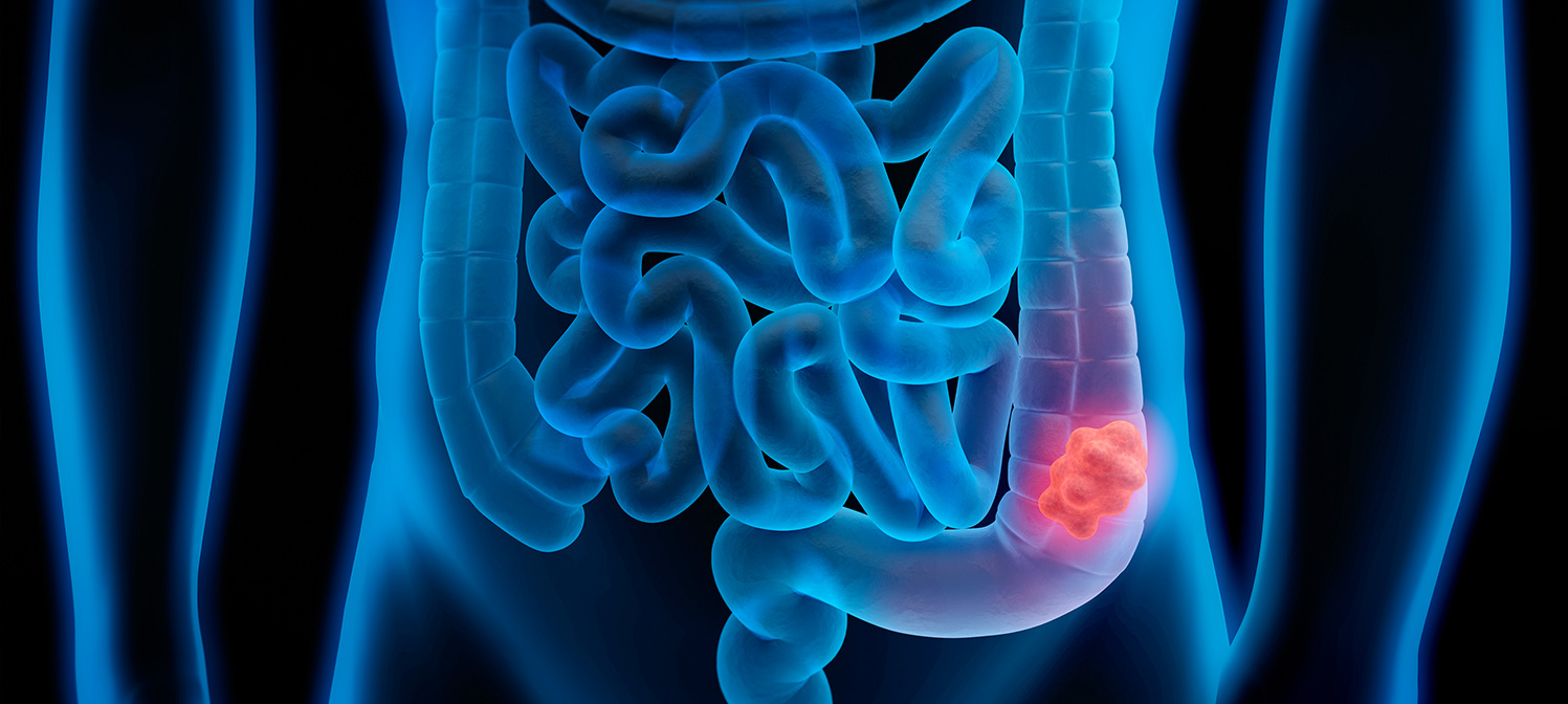 cancer colon