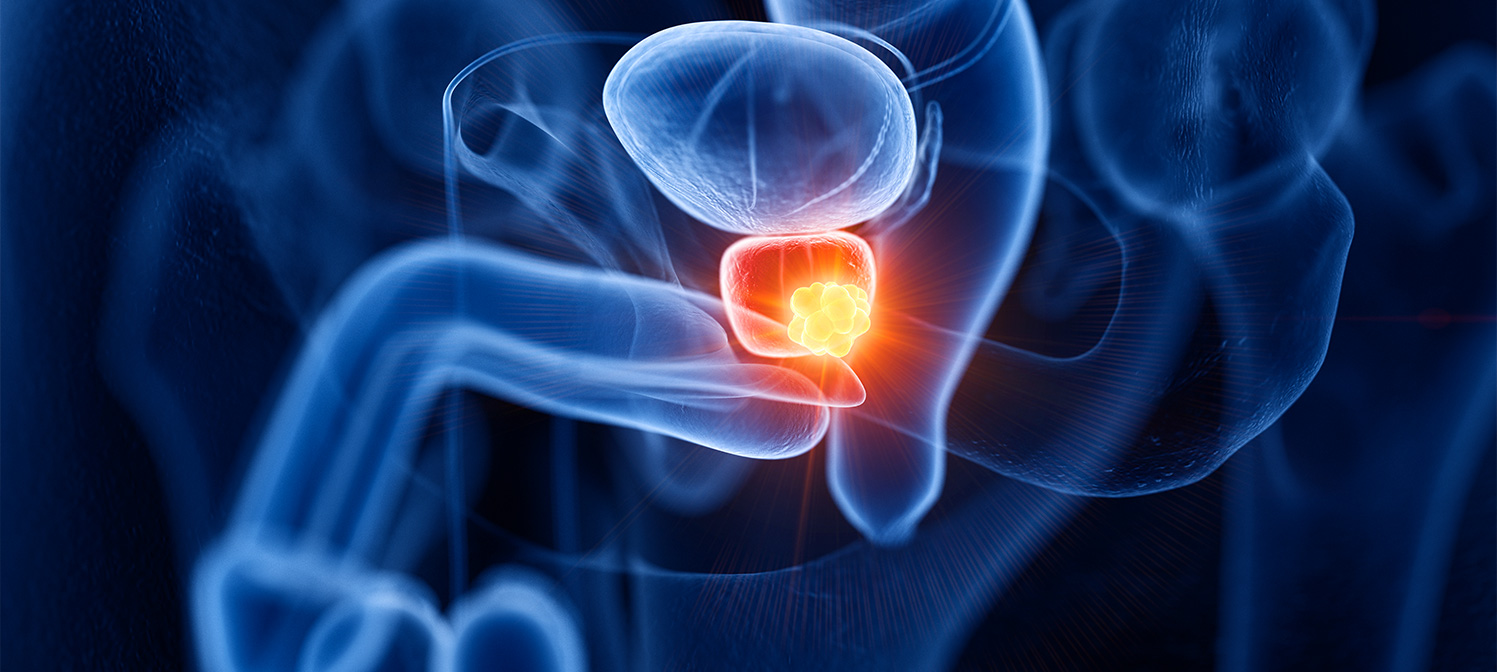 cancer prostate