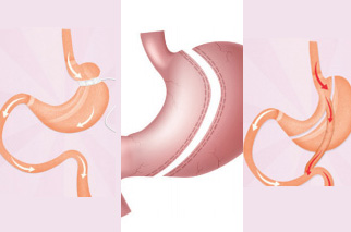 interventions de chirurgie bariatrique