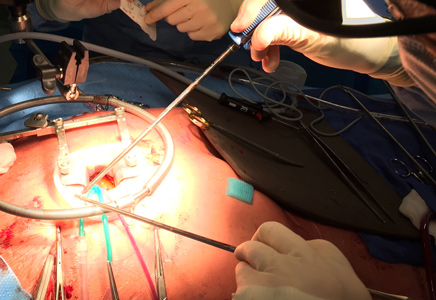 L’innovation en chirurgie aortique à Lyon pour le confort du patient