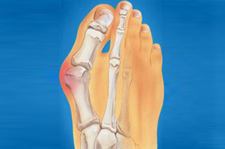 traiter l'hallux valgus à lyon