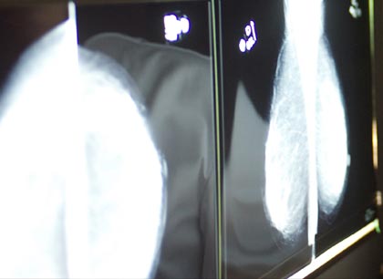 Mammographie