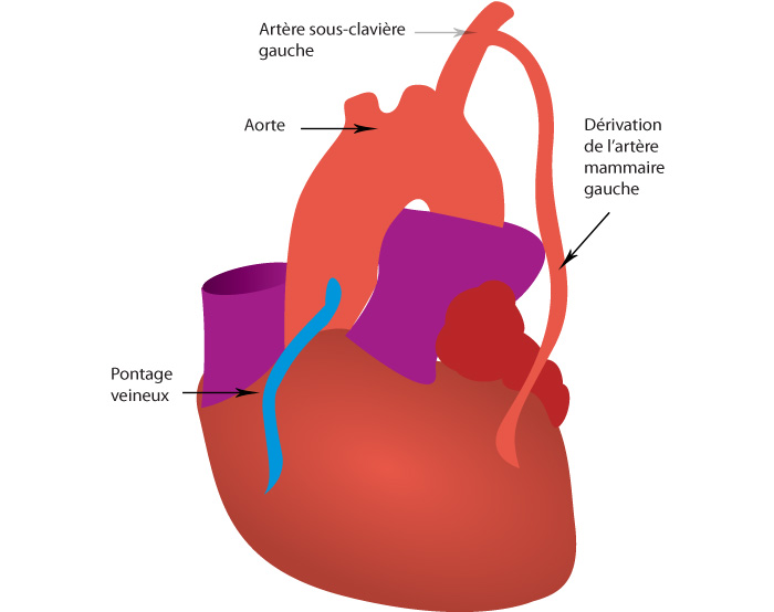 Pontage coronarien