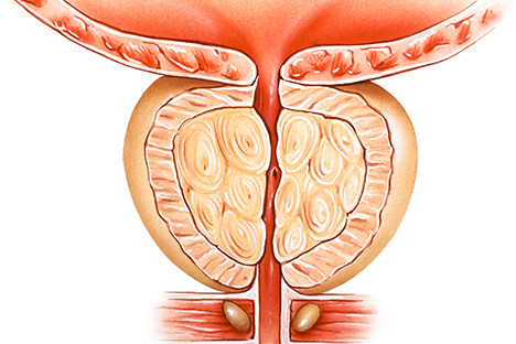 comment savoir si on à un cancer de la prostate