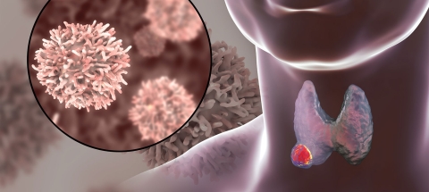 Cancer thyroide