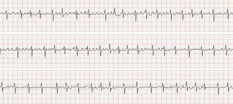 electrocardiogramme