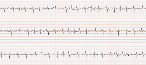 electrocardiogramme