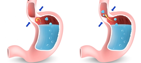 reflux gastro-oesophagien