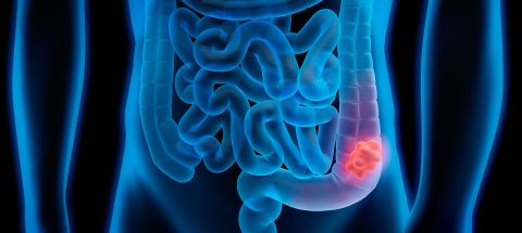 cancer colon