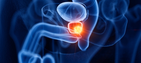 cancer prostate