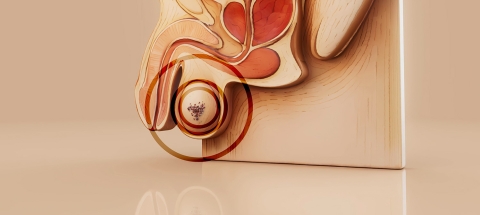 cancer testicules