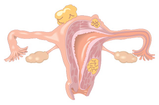 Hystérectomie